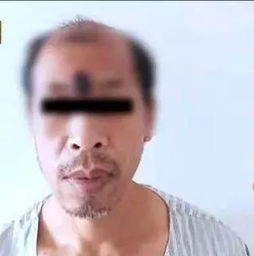 广东省一地92名猴痘患者均为男性