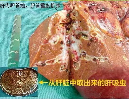 男子爱吃生腌胆道惊现7条虫