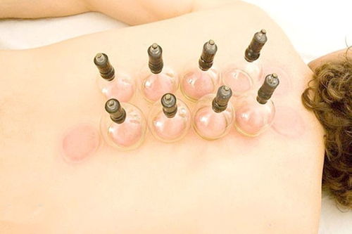 女生美容院拔罐后变身紫薯精的奇妙经历 女生美容院拔罐后变身紫薯精的奇妙经历