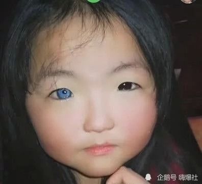 医生回应7岁女孩天生异瞳 医生回应7岁女孩天生异瞳