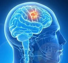 年轻人脑卒中发病率逐步增加