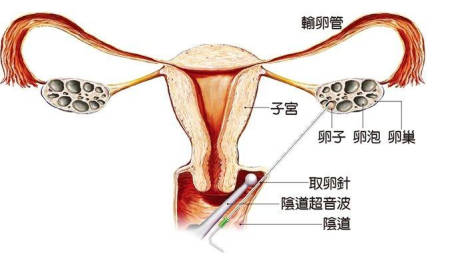 江西首例试管婴儿当妈妈了_江西首例试管婴儿当妈妈了没